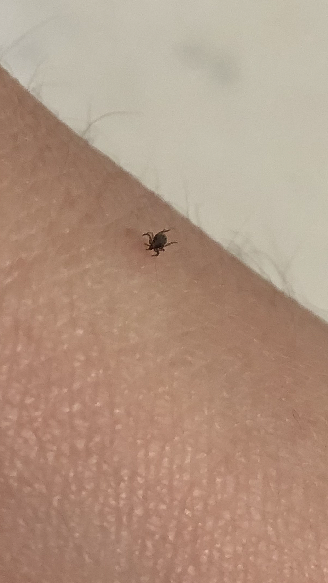 01 tick bite.PNG