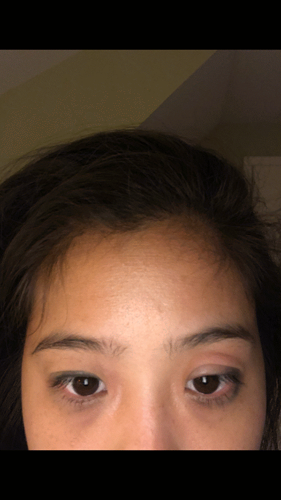 mosquito bite.gif